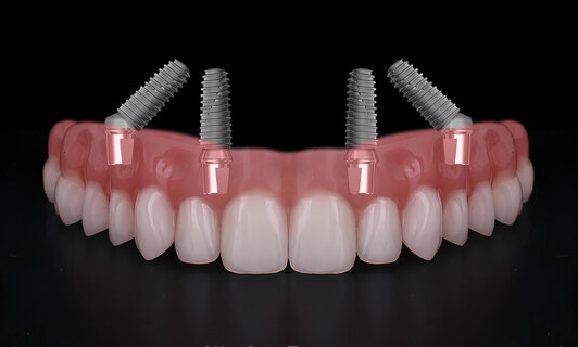 All On 4 Dental Implants - JB Dental Associates