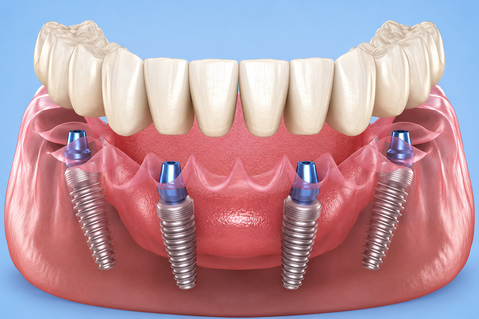 All on 4 dental implants 4 - Sterling VA