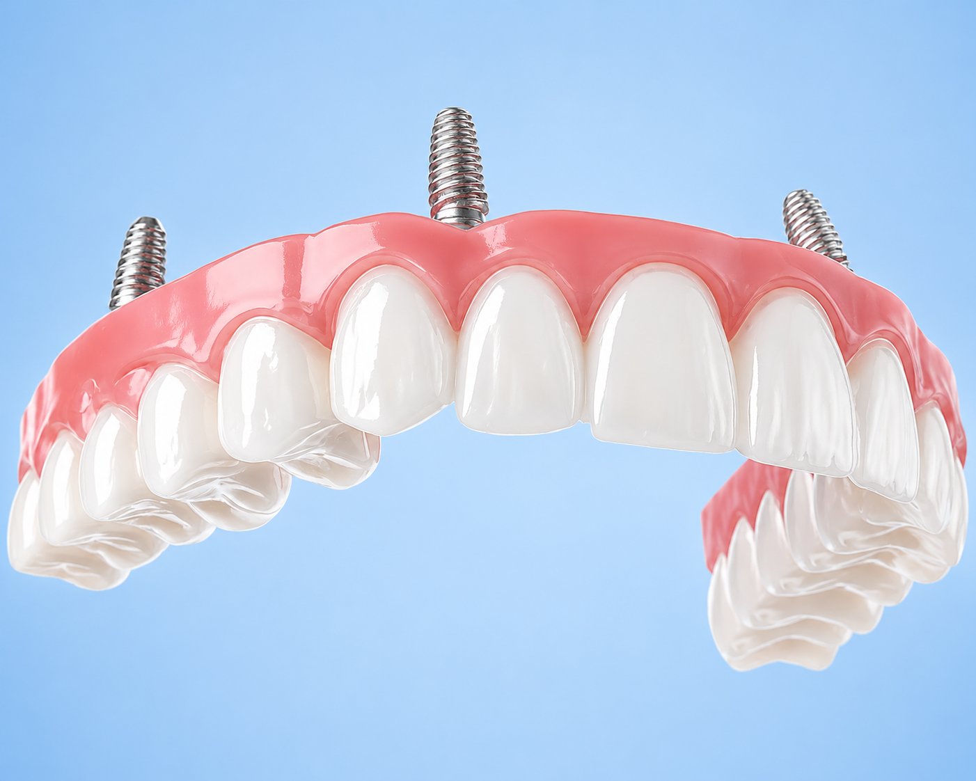 All on 4 dental implants in Sterling VA