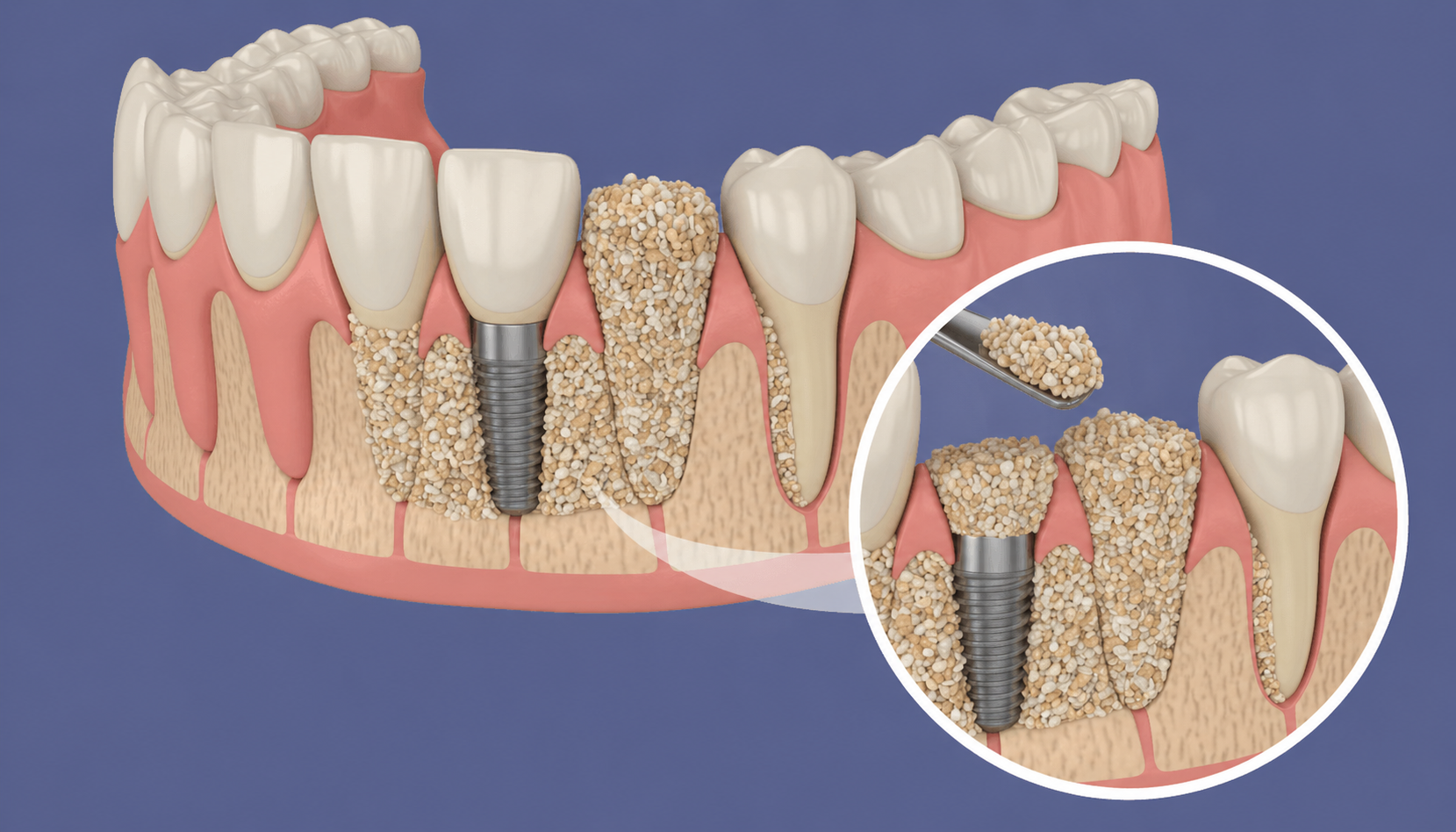 Bone Grafting Treatment in Sterling VA