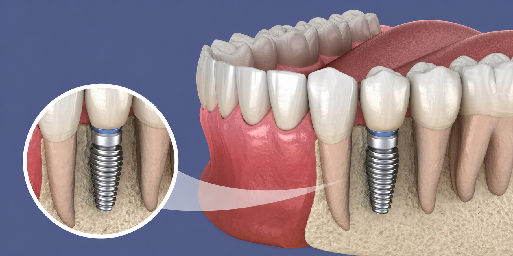 Bone Grafting Treatment in Sterling VA 2