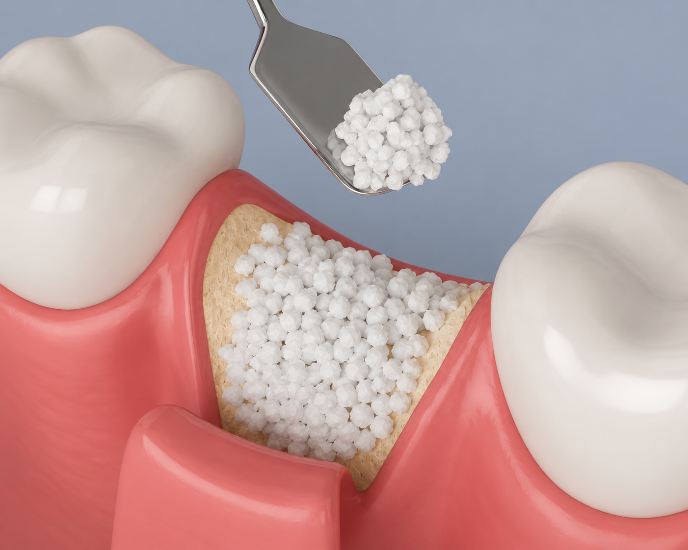Bone Grafting Treatment 3