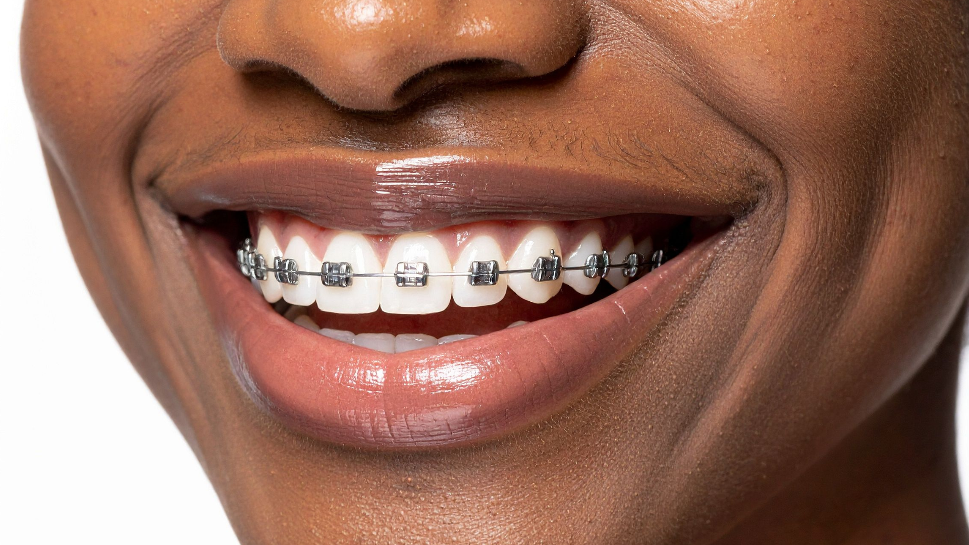 Braces for children, teens and adults in sterling VA