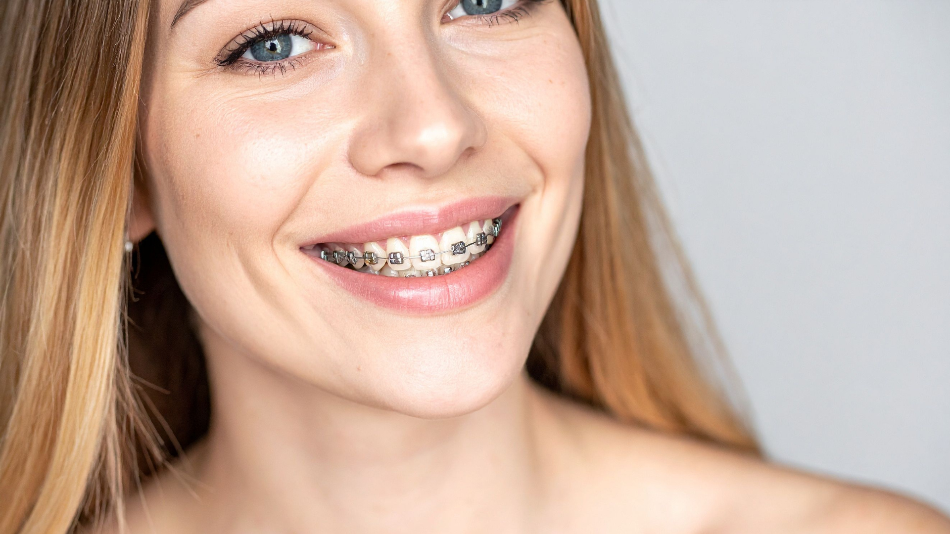 Braces For Teens and Adults in Sterling VA