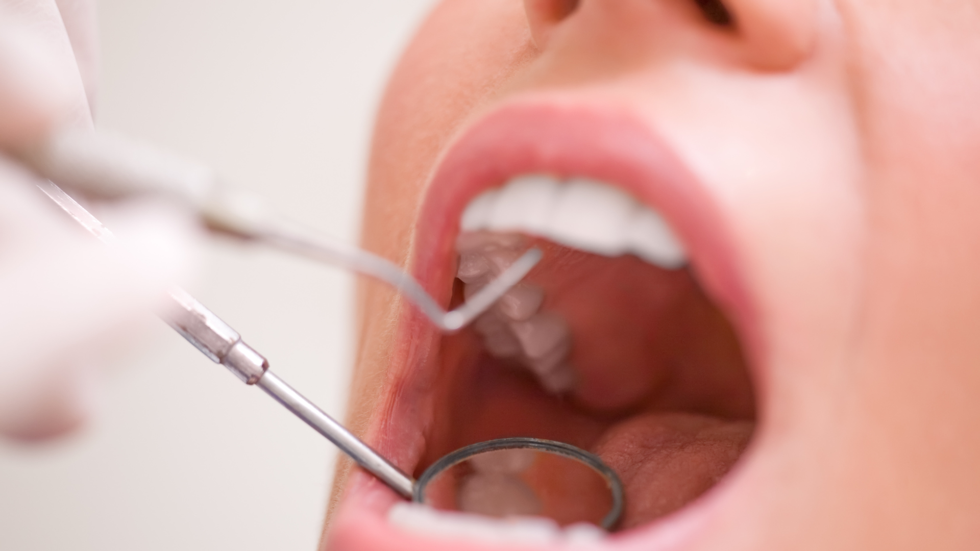 Dental Bonding In sterling VA - JB Dental Associates