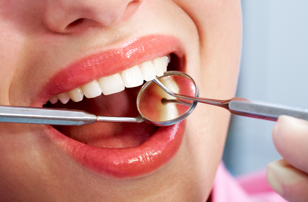 Dental Bonding for cosmetic fixes