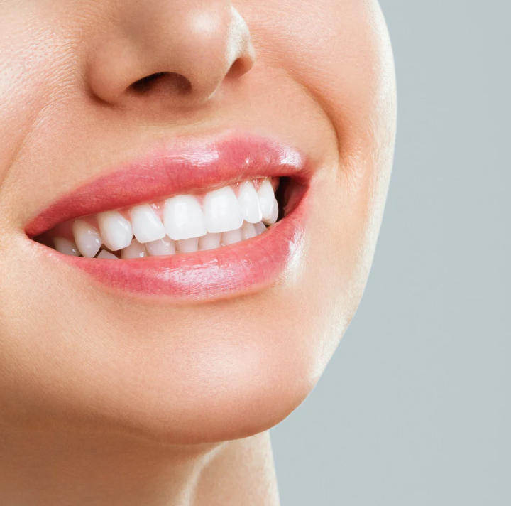 Dental Bonding by JB dental Associates