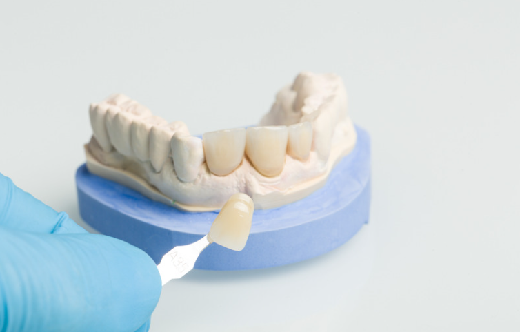 Dental Crowns in Sterling VA