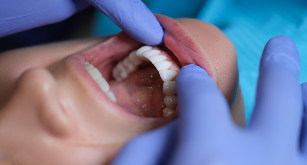 Dental Extractions - JB Dental Associates