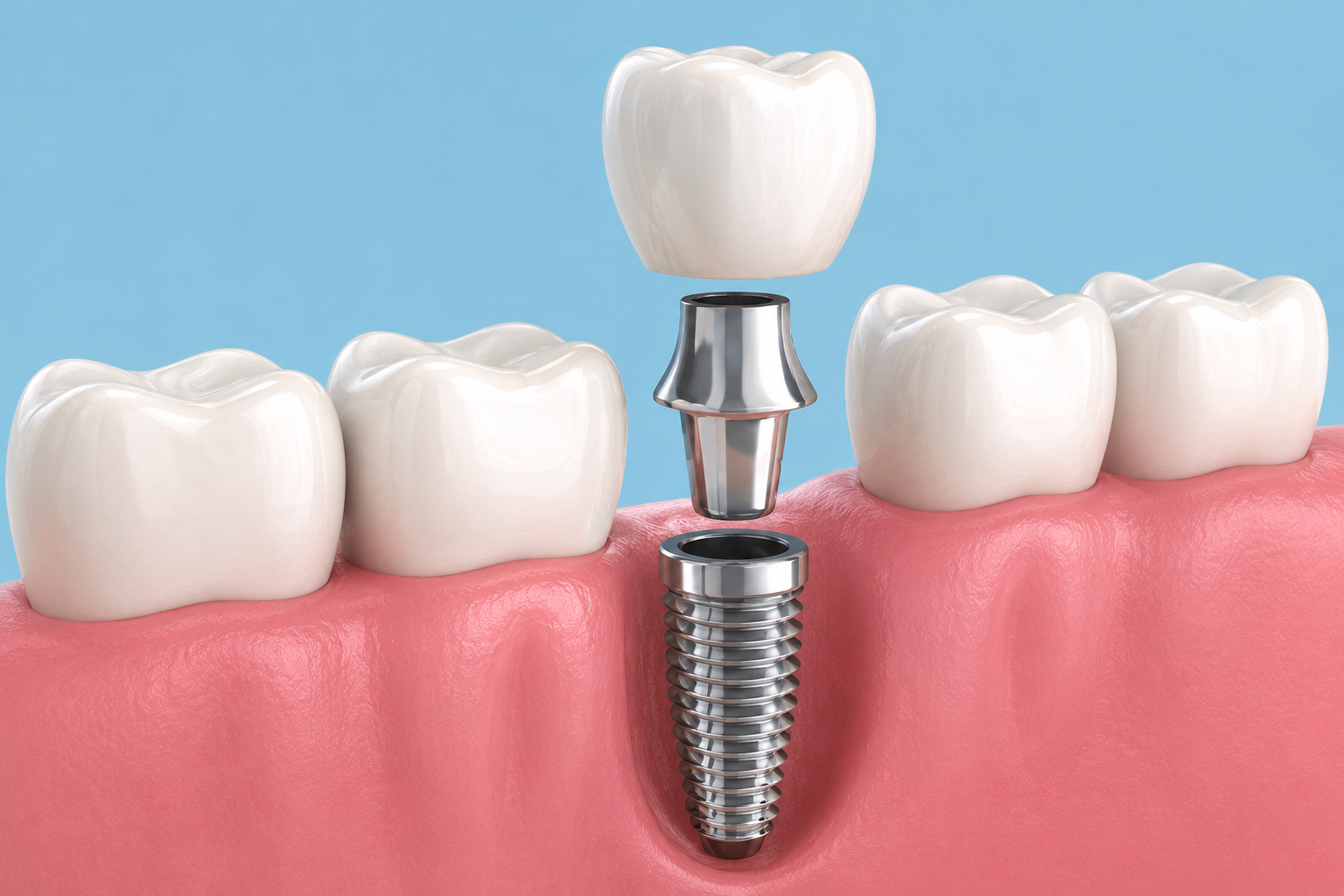 Dental Implant - Sterling VA