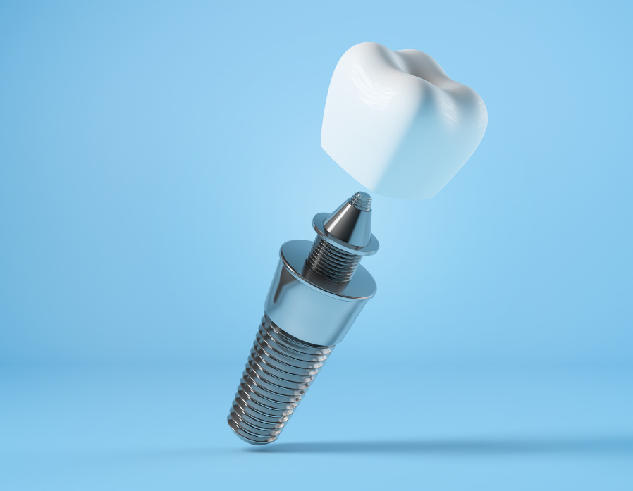 Dental Implants in Sterling VA