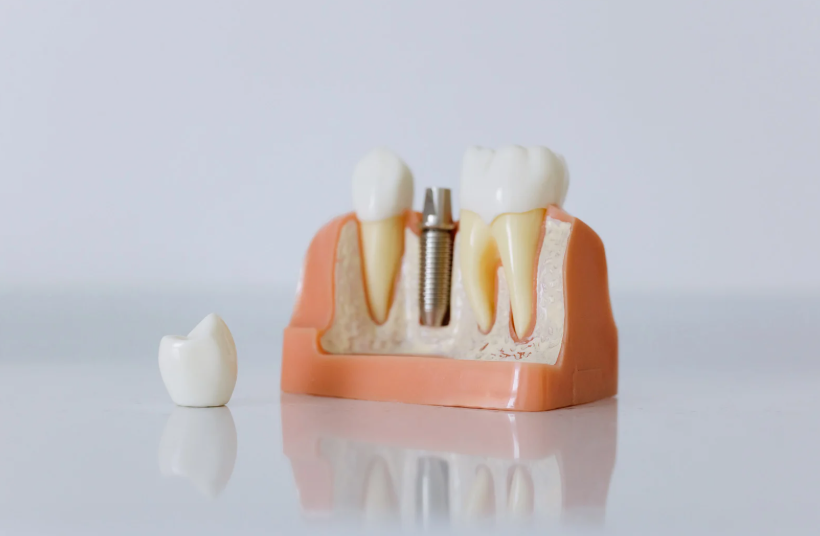 Dental Implants - JB Dental Group