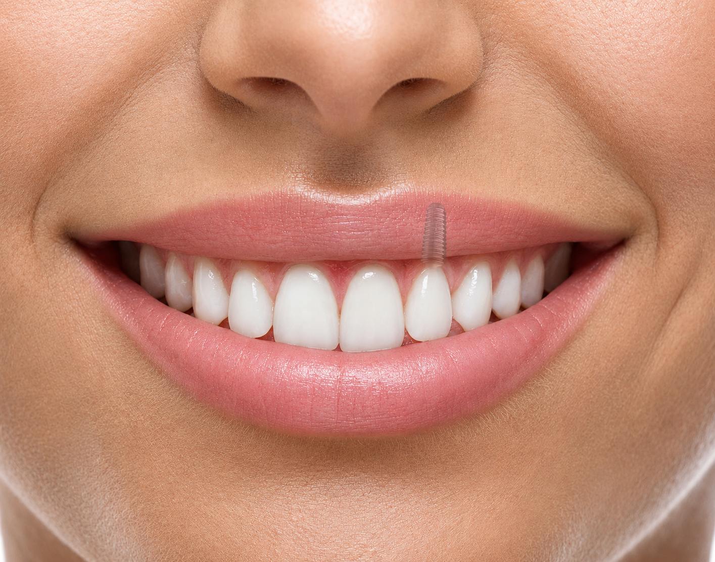 Dental Implants - Sterling's Trusted Dental Implants Provider