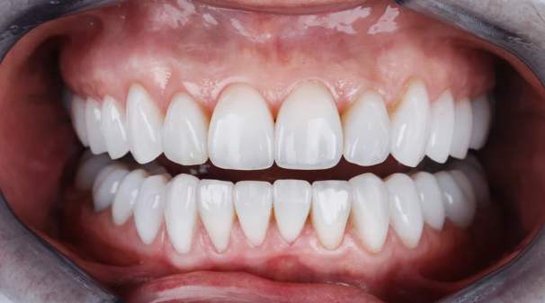 Dental Implants to transform your smile