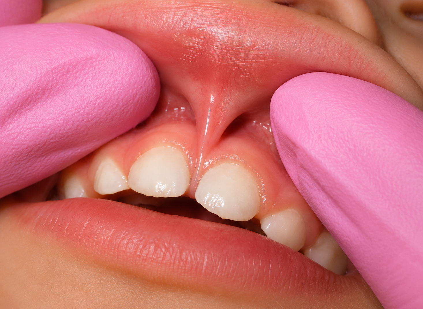 Lip tie treatment in Sterling VA