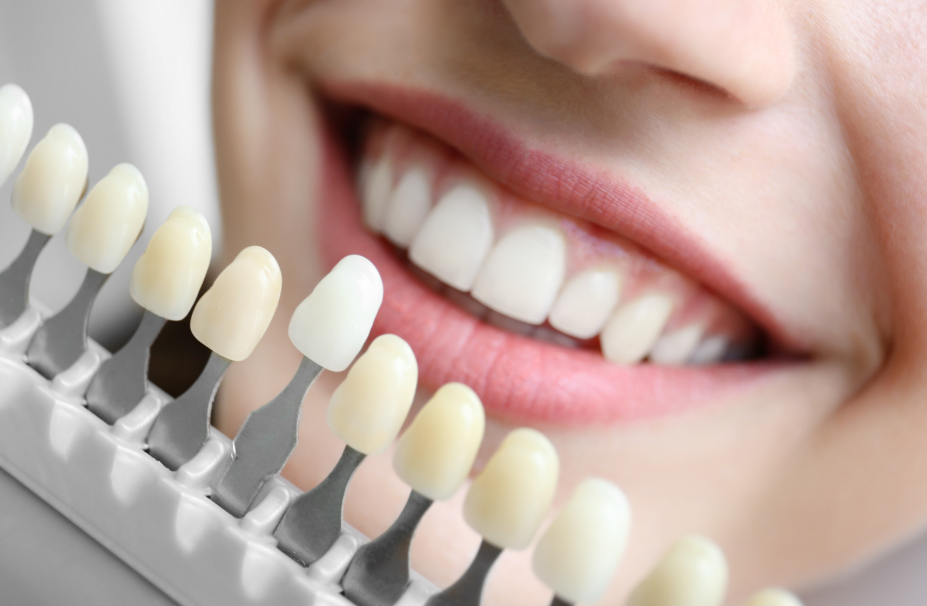 Teeth Whitening in Sterling VA