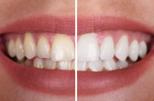 Teeth Whitening Before and After - JB Dental Associates