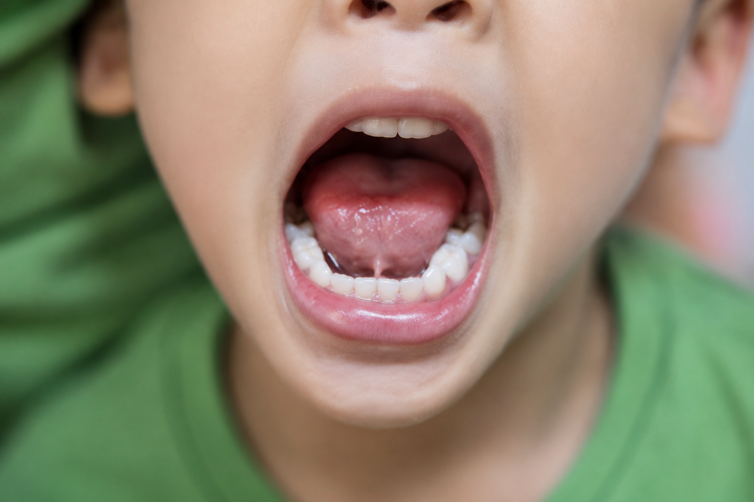 tongue tie & Lip Tie in Children