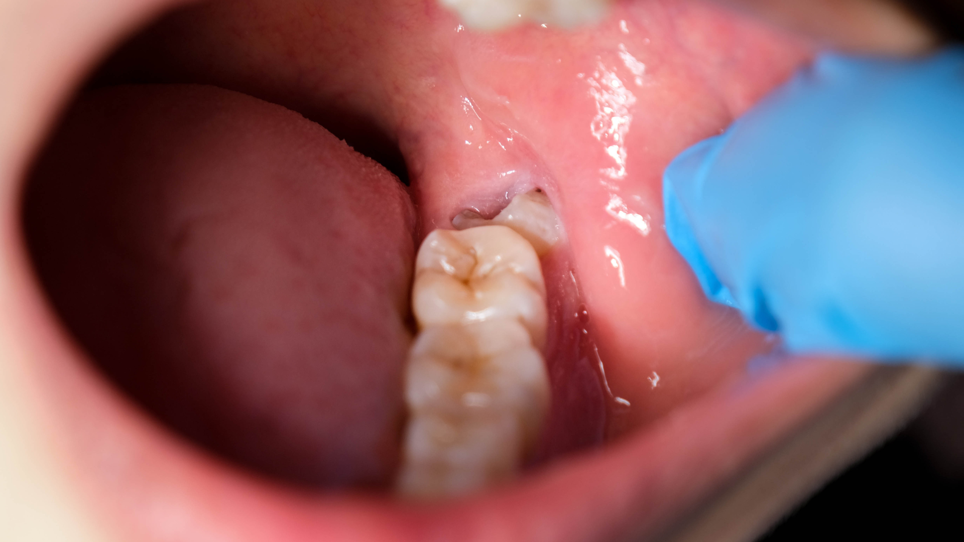 Wisdom Teeth Extractions - Sterling VA