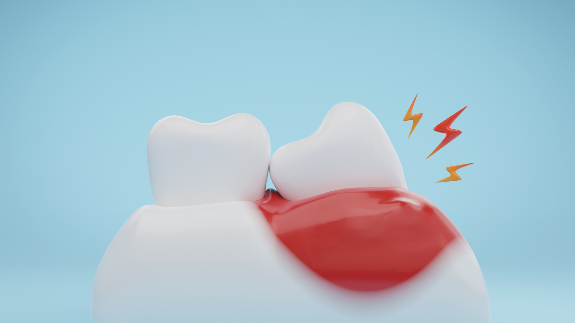 Wisdom Teeth Extractions done by JB Dental Group. Safe gentle removal in sterling VA