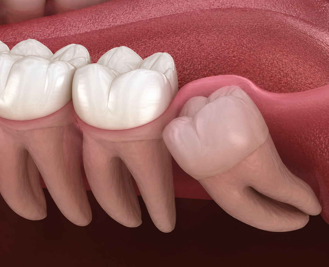 Wisdom teeth Extractions in sterling va